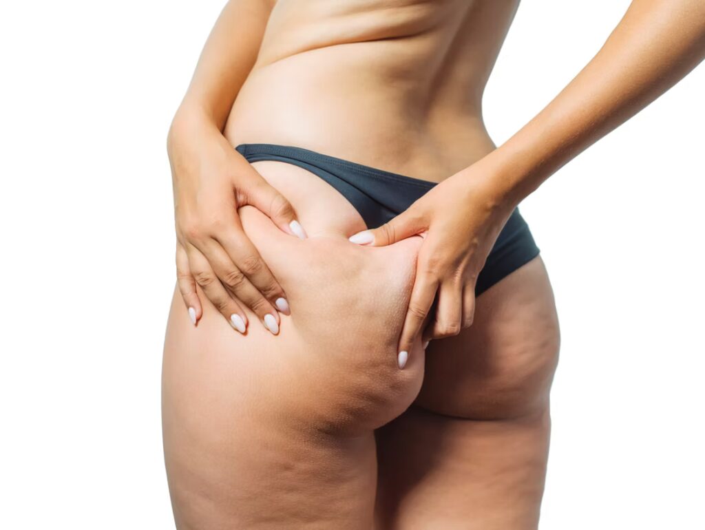 Cellulite is often misunderstood 